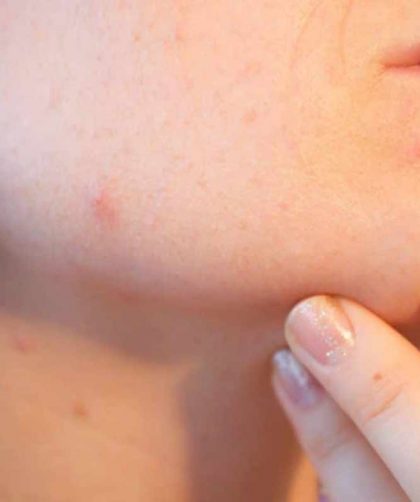 Tutti i rimedi per il trattamento de acne