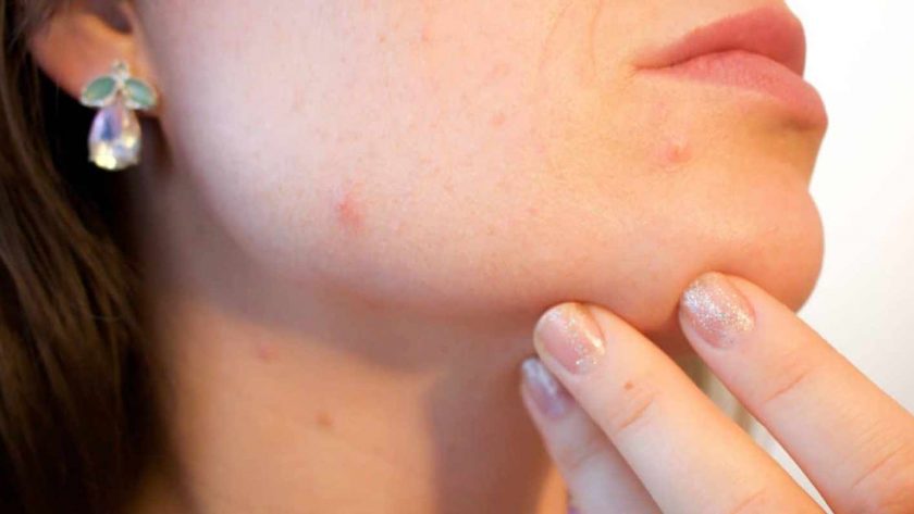 Tutti i rimedi per il trattamento de acne