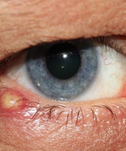 Infiammazione cutanea trattamenti e prevenzione